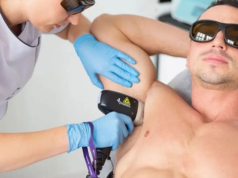 Ice Laser Hair Removal For Men