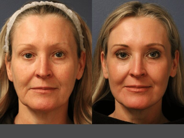 co2 fractional laser