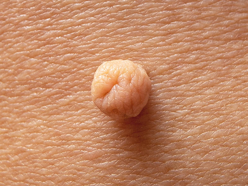 Skin Tag