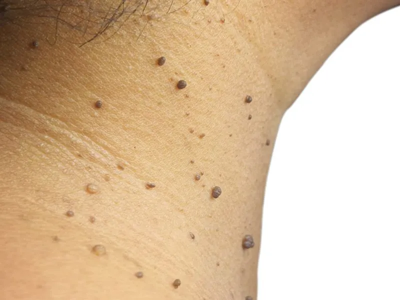 skin tag removal