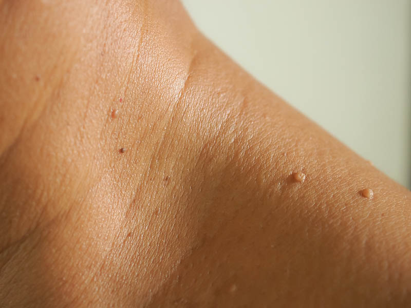 skin tag istanbul