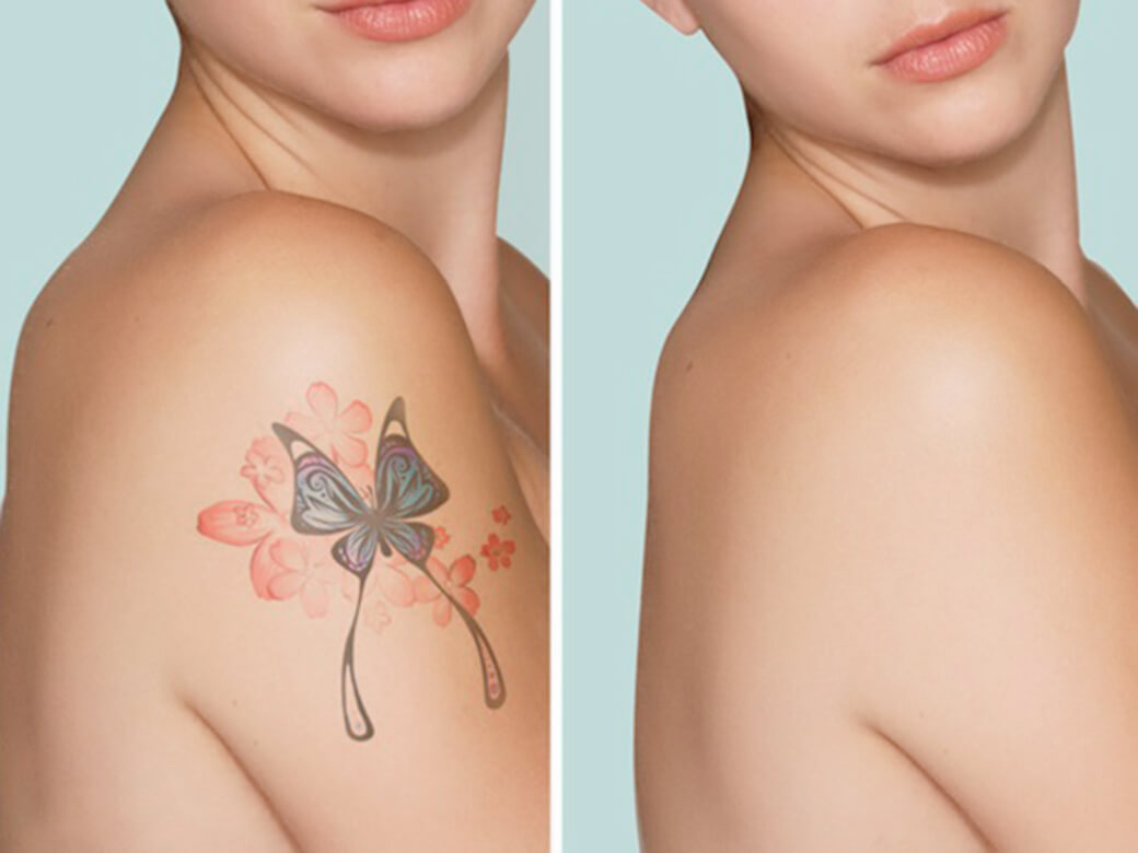 tatto removal