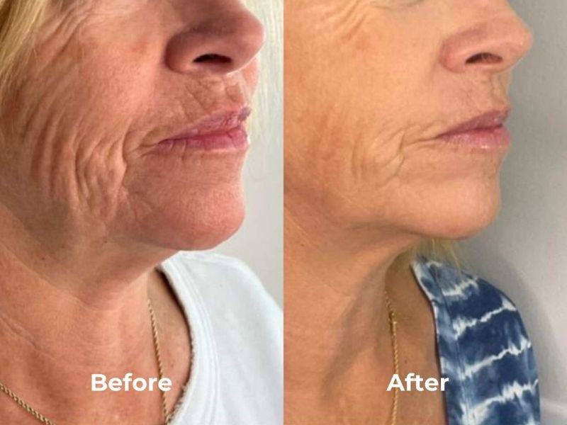 RF Microneedling is a minimally invasive cosmetic procedure that combines the benefits of traditional microneedling with the power of radiofrequency (RF) energy. This innovative treatment stimulates collagen and elastin production in the deeper layers of your skin, leading to significant improvements in skin texture, tone, and overall appearance