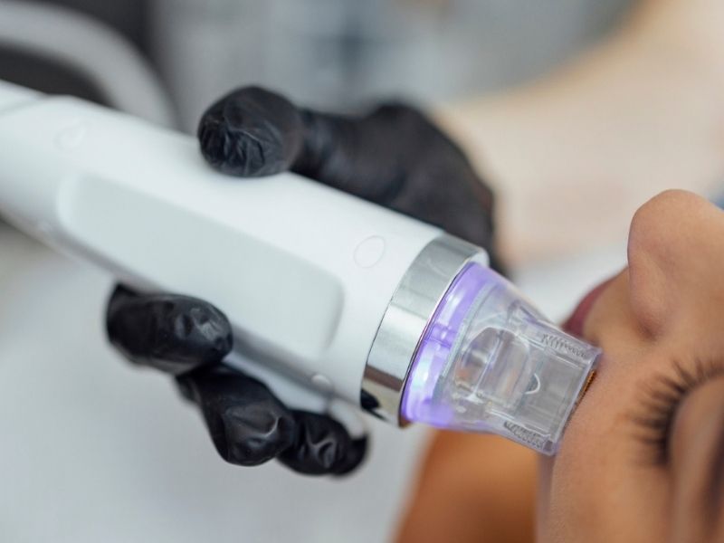 RF Microneedling is a minimally invasive cosmetic procedure that combines the benefits of traditional microneedling with the power of radiofrequency (RF) energy. This innovative treatment stimulates collagen and elastin production in the deeper layers of your skin, leading to significant improvements in skin texture, tone, and overall appearance