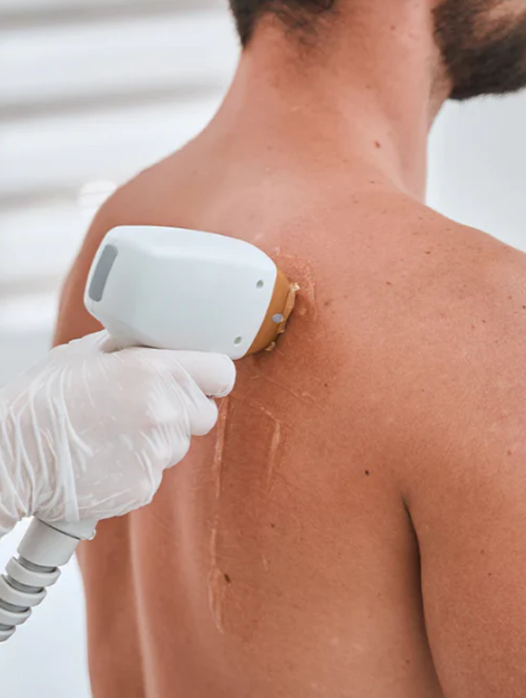 Erkek Lazer Epilasyon 7 men hair laser epilation