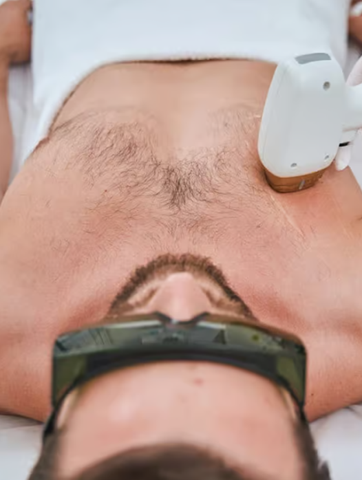 Erkek Lazer Epilasyon 8 men hair laser epilation