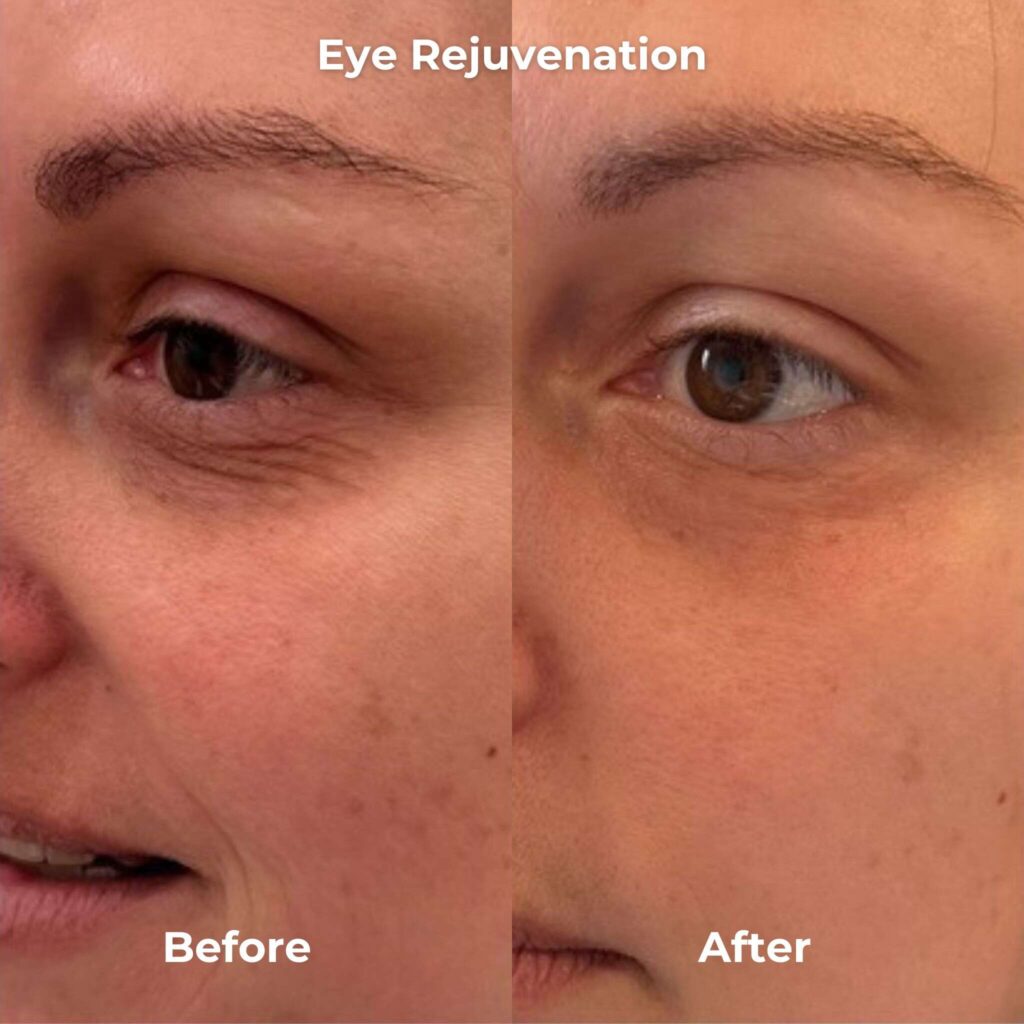 rf microneedling before and after virtue rf eye rejuvenation 1