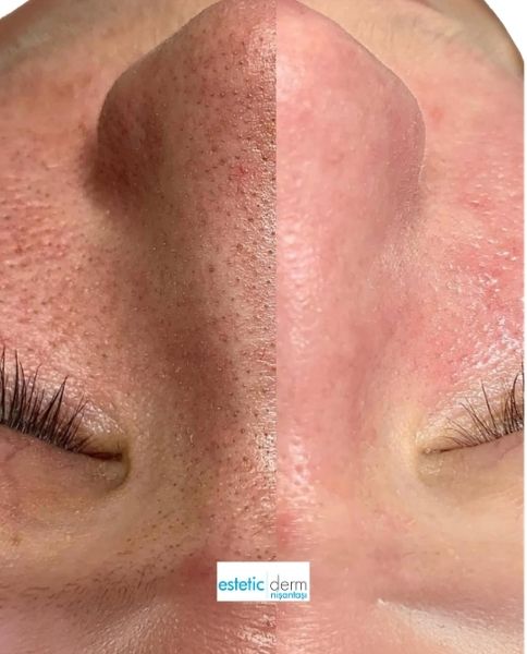 hydrafacial