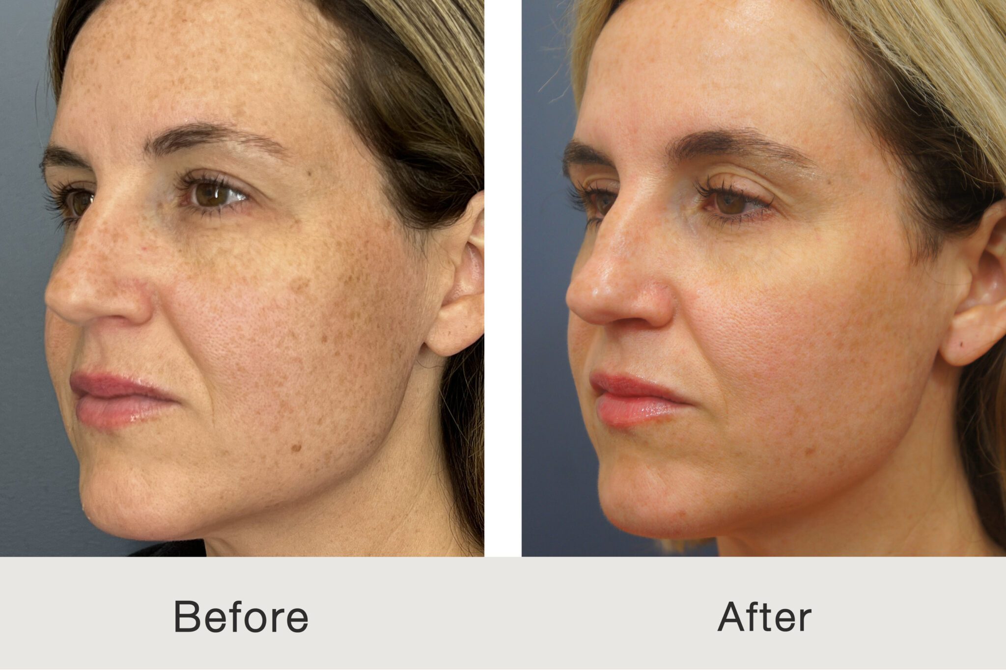 CO2 Laser Resurfacing in Istanbul 14 kulbersh carolina facial plastics charlotte bbl hero laser before after2 scaled 1 edited