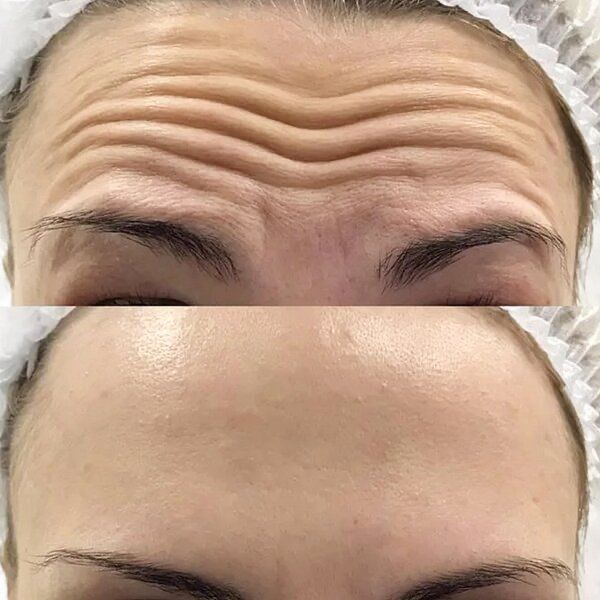 Wrinkle Treatment Istanbul 2 a6356285 a167 414a b6cf c8207788fd77