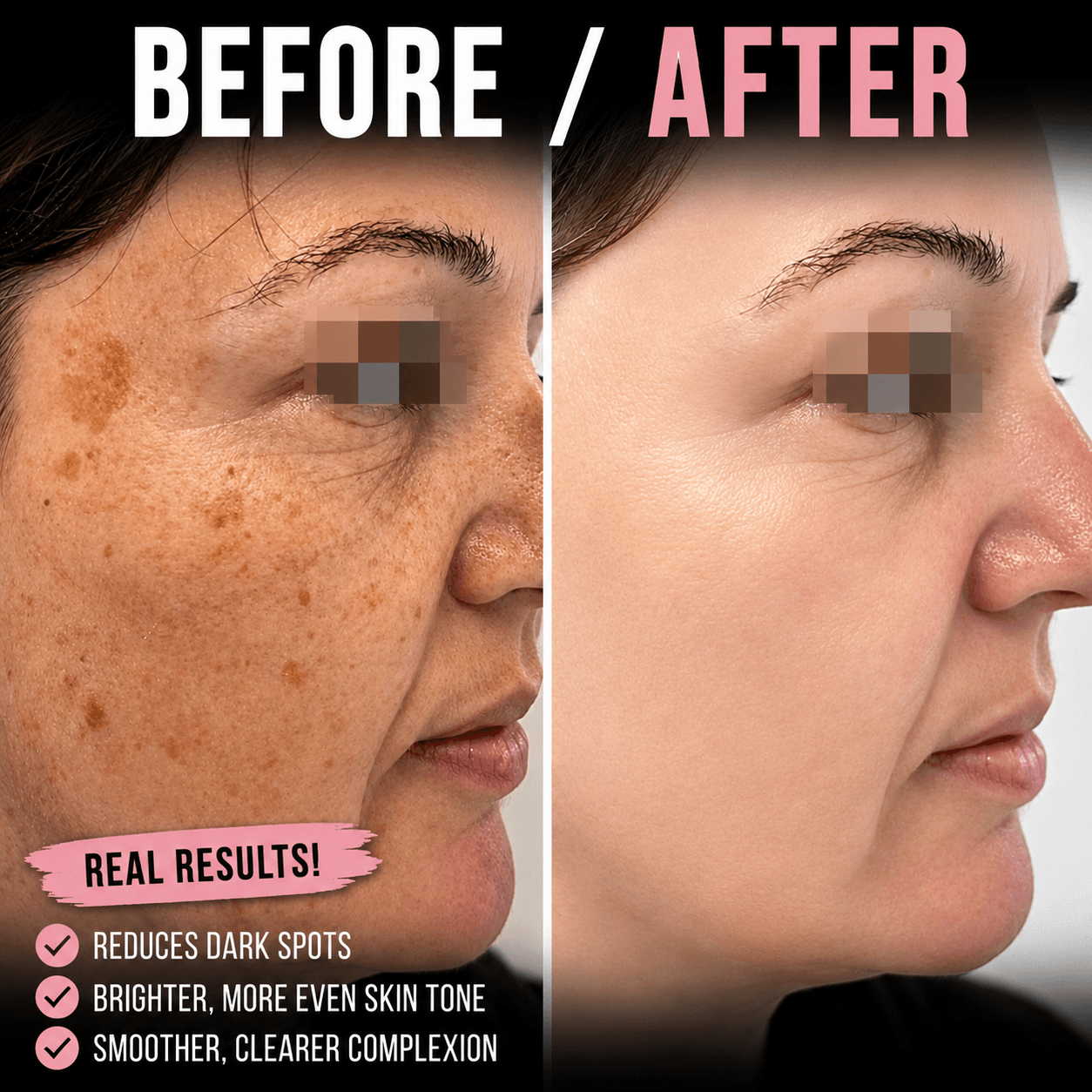 Fractional Laser Istanbul | CO2 Skin 10 beforeafter