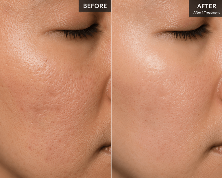 Fractional Laser Istanbul | CO2 Skin 5 gallery5