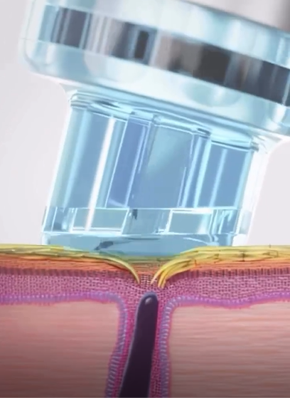 hydrafacial image